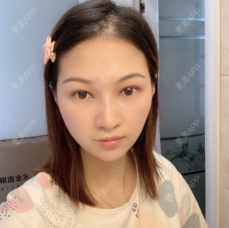更美 - 优美酱的鼻部多项经验 | 肋软骨隆鼻 | 自体肋软骨垫鼻基底 | 鼻部多项 | 鼻小柱延长 | 鼻部膨体假体取出