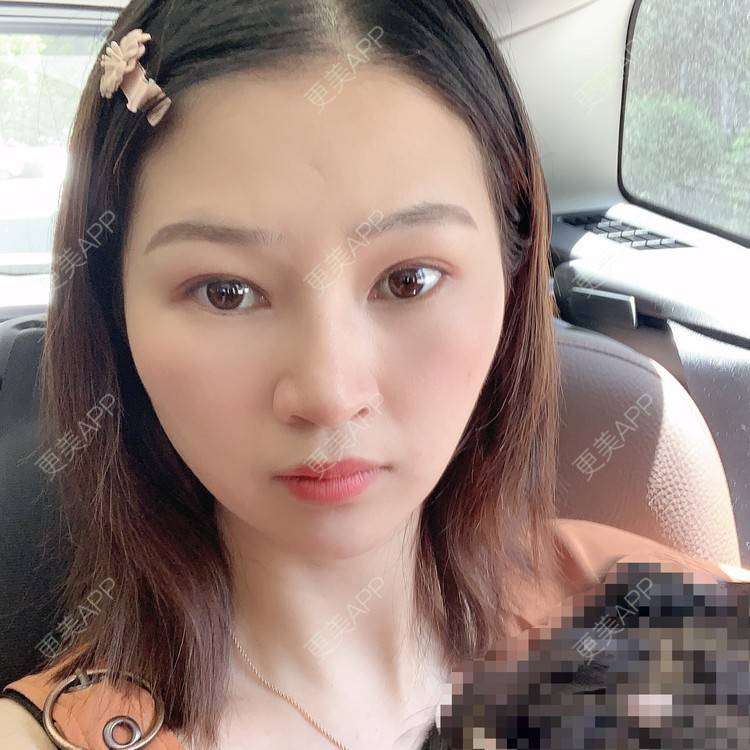 更美 - 优美酱的鼻部多项经验 | 肋软骨隆鼻 | 自体肋软骨垫鼻基底 | 鼻部多项 | 鼻小柱延长 | 鼻部膨体假体取出