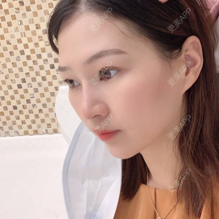 更美 - 优美酱的鼻部多项经验 | 肋软骨隆鼻 | 自体肋软骨垫鼻基底 | 鼻部多项 | 鼻小柱延长 | 鼻部膨体假体取出