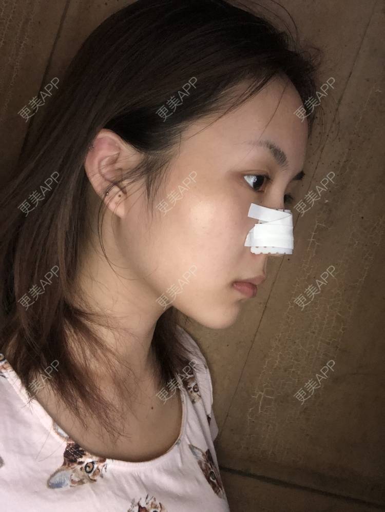 更美 - 更美用户aujlWhrgzx的鼻部多项经验 | 鼻部多项 | 广州