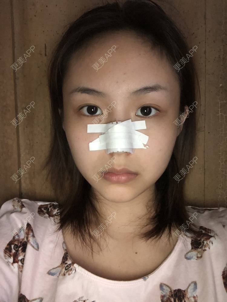 更美 - 更美用户aujlWhrgzx的鼻部多项经验 | 鼻部多项 | 广州