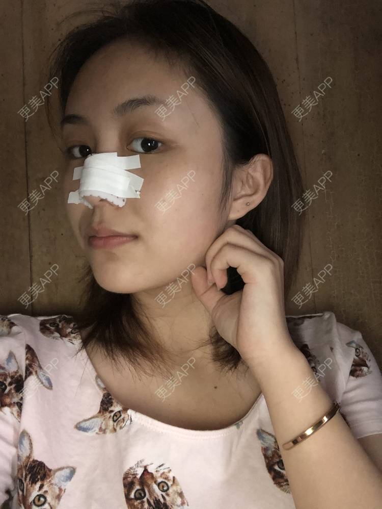 更美 - 更美用户aujlWhrgzx的鼻部多项经验 | 鼻部多项 | 广州