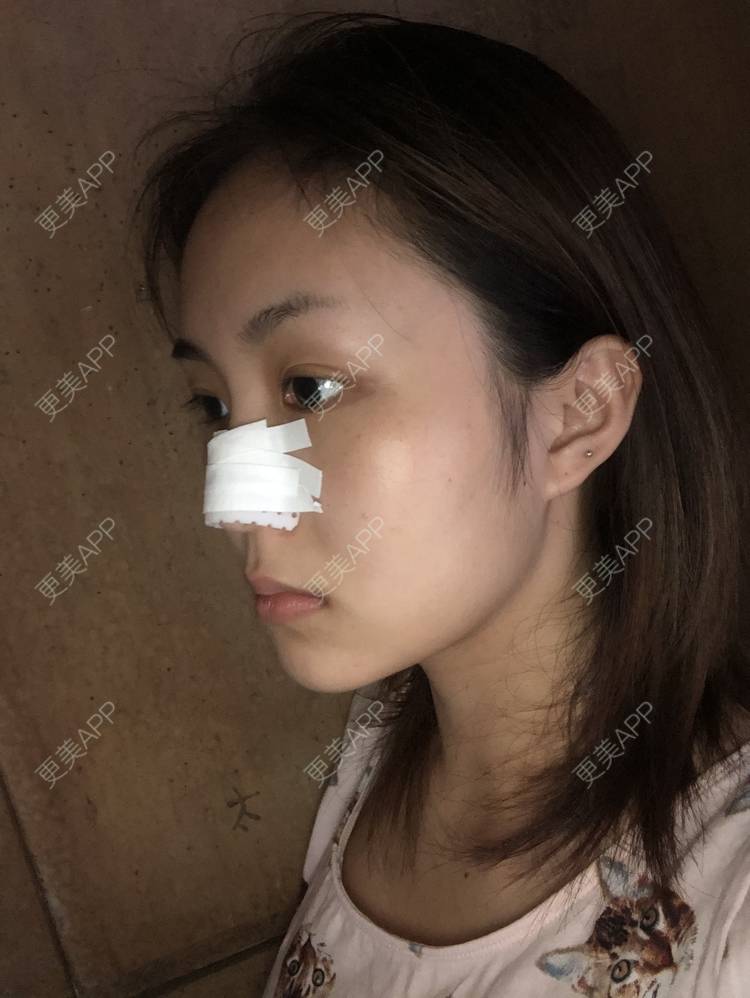 更美 - 更美用户aujlWhrgzx的鼻部多项经验 | 鼻部多项 | 广州