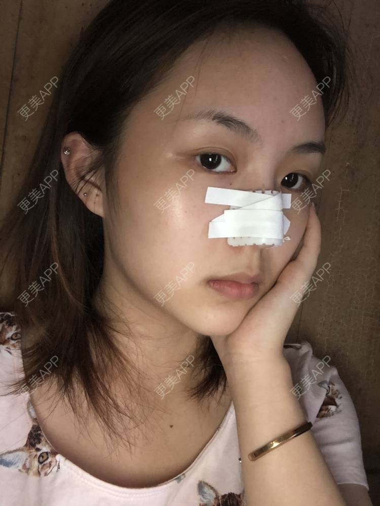 更美 - 更美用户aujlWhrgzx的鼻部多项经验 | 鼻部多项 | 广州