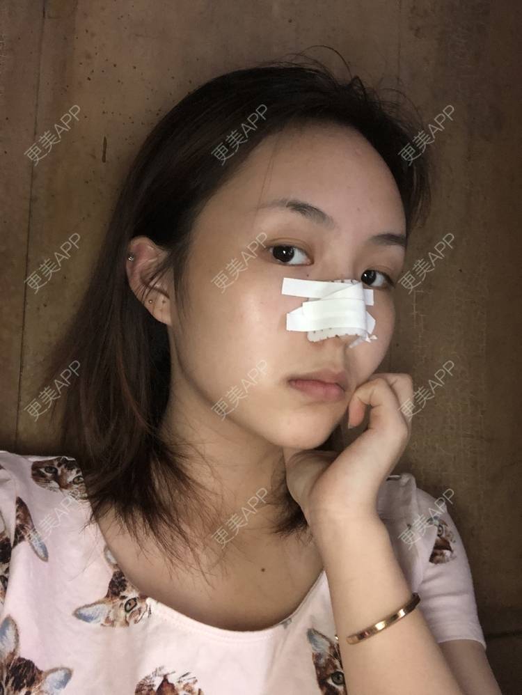 更美 - 更美用户aujlWhrgzx的鼻部多项经验 | 鼻部多项 | 广州