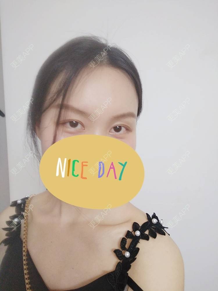 更美 - 更美用户1fHxMDJVIE的眼部多项经验 | 眼部多项 | 广州