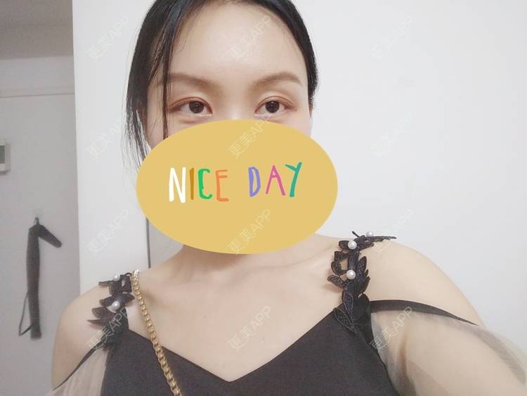 更美 - 更美用户1fHxMDJVIE的眼部多项经验 | 眼部多项 | 广州