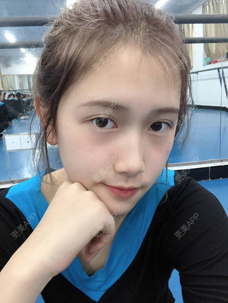 更美 - 更美用户ezaery6fSs的眼部多项经验 | 眼部多项 | 广州 | 视频日记