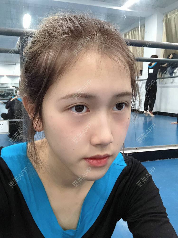 更美 - 更美用户ezaery6fSs的眼部多项经验 | 眼部多项 | 广州 | 视频日记