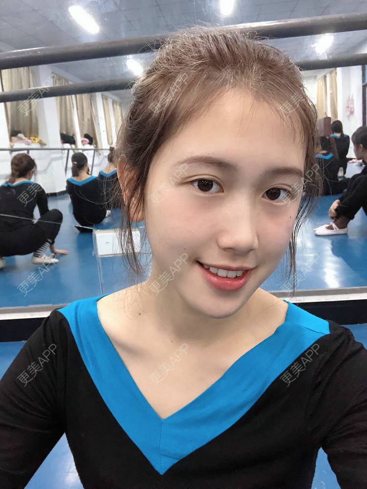 更美 - 更美用户ezaery6fSs的眼部多项经验 | 眼部多项 | 广州 | 视频日记