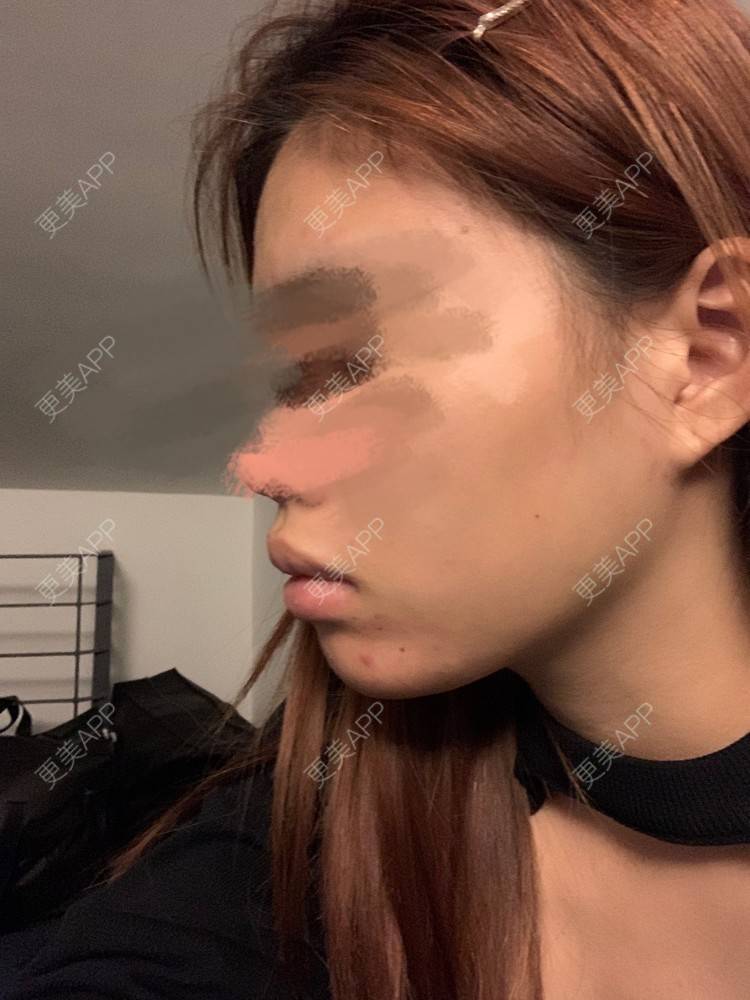 更美 - 更美用户DWKIxrCW9n的玻尿酸鼻部经验 | 玻尿酸下巴 | 玻尿酸鼻部 | 广州