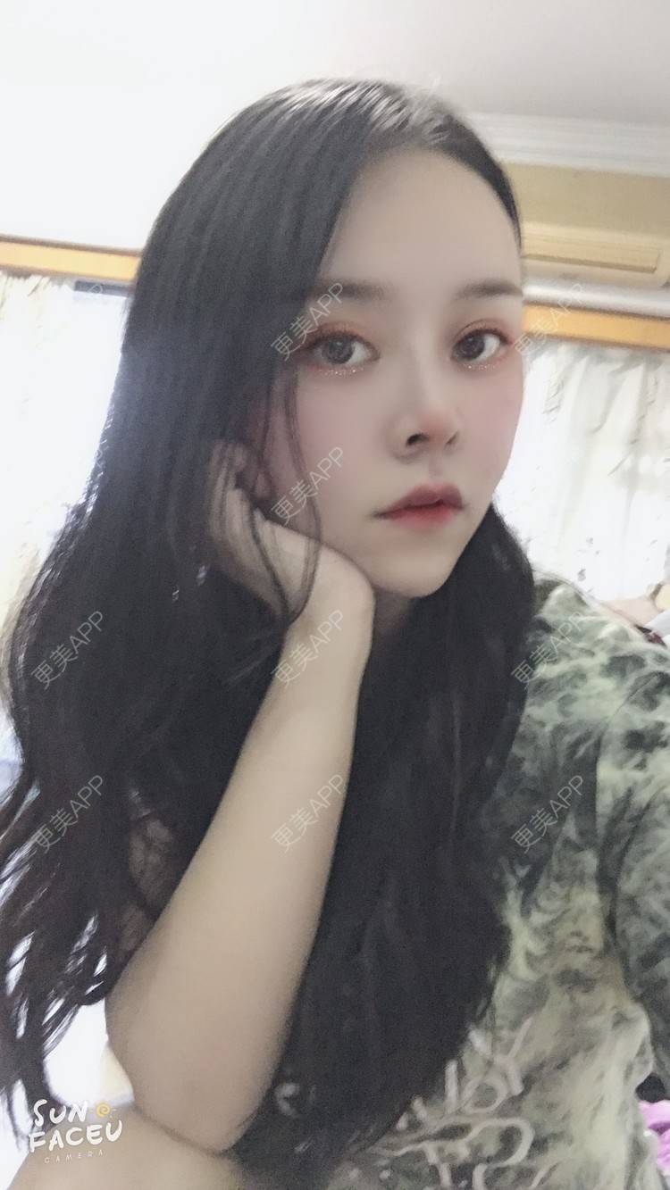 更美 - 更美用户iuB00h31N3的鼻部多项经验 | 鼻部多项 | 肋软骨隆鼻 | 广州
