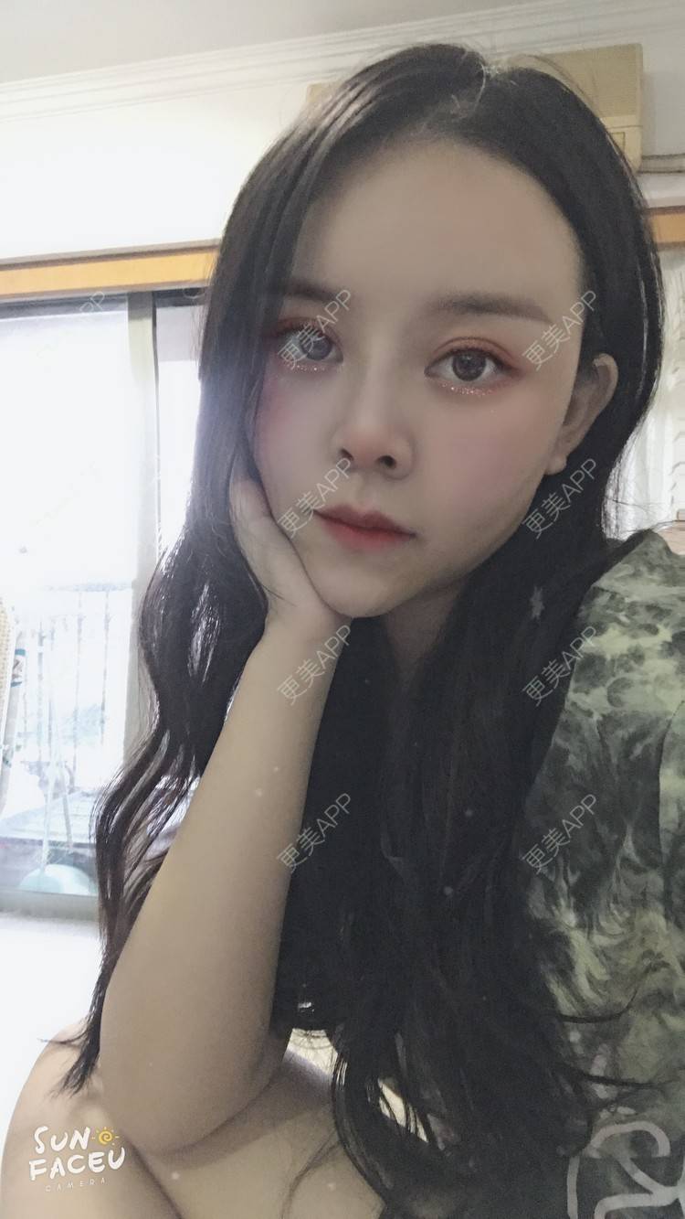 更美 - 更美用户iuB00h31N3的鼻部多项经验 | 鼻部多项 | 肋软骨隆鼻 | 广州
