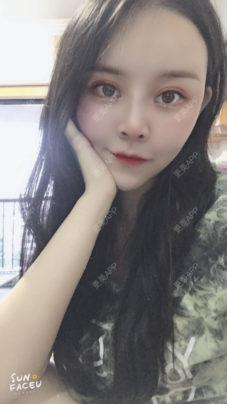 更美 - 更美用户iuB00h31N3的鼻部多项经验 | 鼻部多项 | 肋软骨隆鼻 | 广州