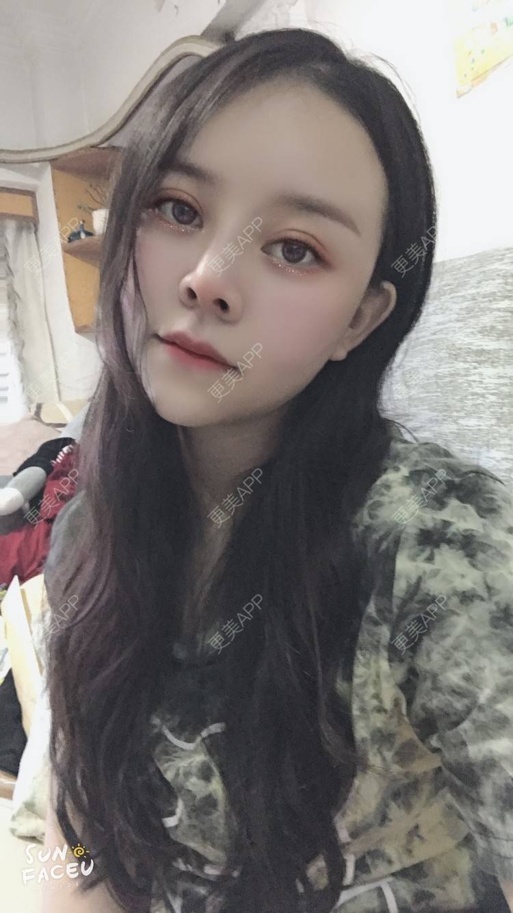更美 - 更美用户iuB00h31N3的鼻部多项经验 | 鼻部多项 | 肋软骨隆鼻 | 广州