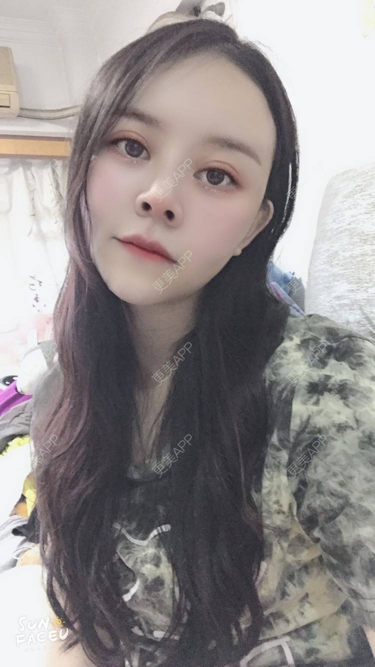 更美 - 更美用户iuB00h31N3的鼻部多项经验 | 鼻部多项 | 肋软骨隆鼻 | 广州