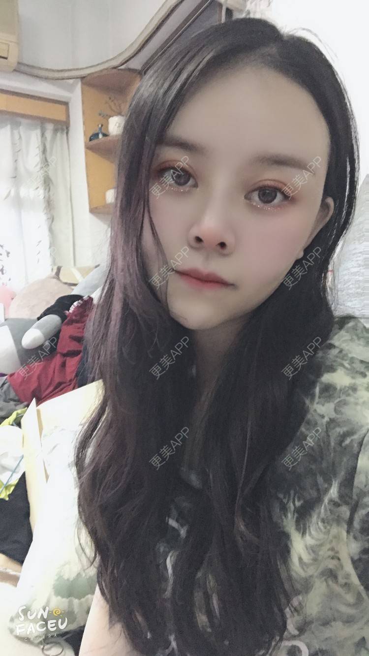 更美 - 更美用户iuB00h31N3的鼻部多项经验 | 鼻部多项 | 肋软骨隆鼻 | 广州