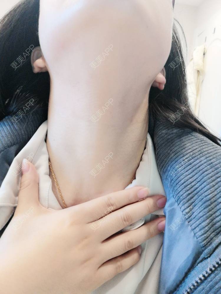 更美 - c年糕的玻尿酸颈纹经验 | 玻尿酸颈纹 | 广州