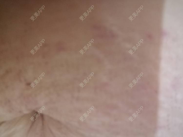更美 - 艾米妈妈！的微针淡化妊娠纹经验 | 秦皇岛 | 微针淡化妊娠纹