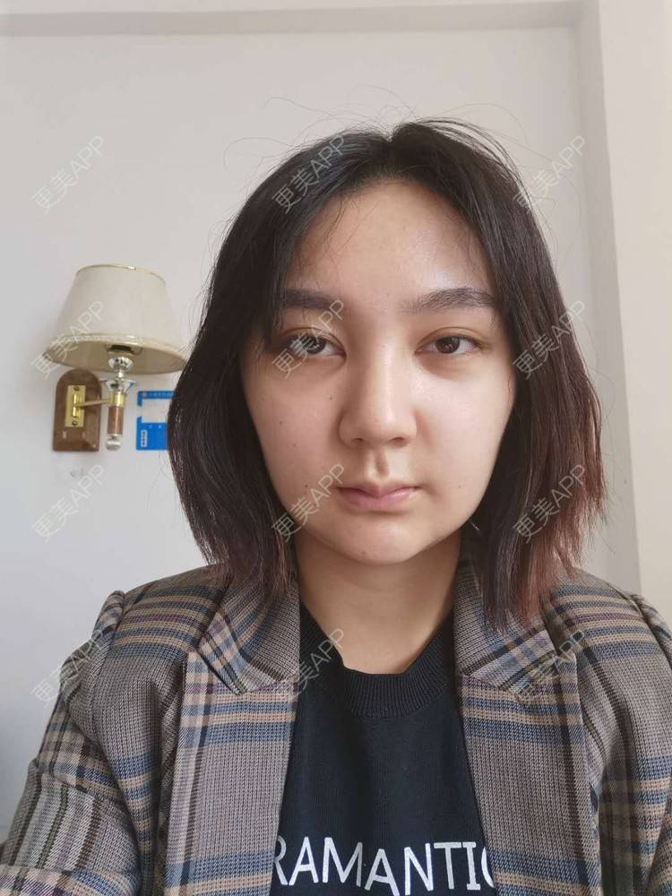 更美 - 更美用户vPlhBD2DXX的自体脂肪丰臀经验 | 自体脂肪丰臀 | 自体脂肪填充面部细纹 | 自体脂肪全面部填充 | 自体脂肪私密紧致