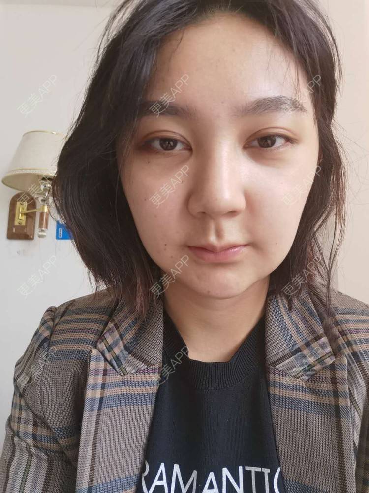 更美 - 更美用户vPlhBD2DXX的自体脂肪丰臀经验 | 自体脂肪丰臀 | 自体脂肪填充面部细纹 | 自体脂肪全面部填充 | 自体脂肪私密紧致