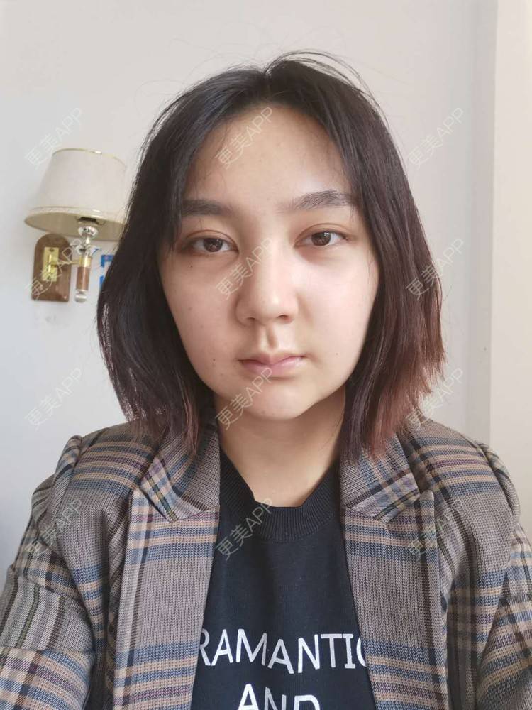 更美 - 更美用户vPlhBD2DXX的自体脂肪丰臀经验 | 自体脂肪丰臀 | 自体脂肪填充面部细纹 | 自体脂肪全面部填充 | 自体脂肪私密紧致