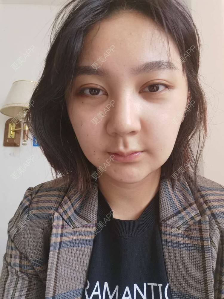 更美 - 更美用户vPlhBD2DXX的自体脂肪丰臀经验 | 自体脂肪丰臀 | 自体脂肪填充面部细纹 | 自体脂肪全面部填充 | 自体脂肪私密紧致