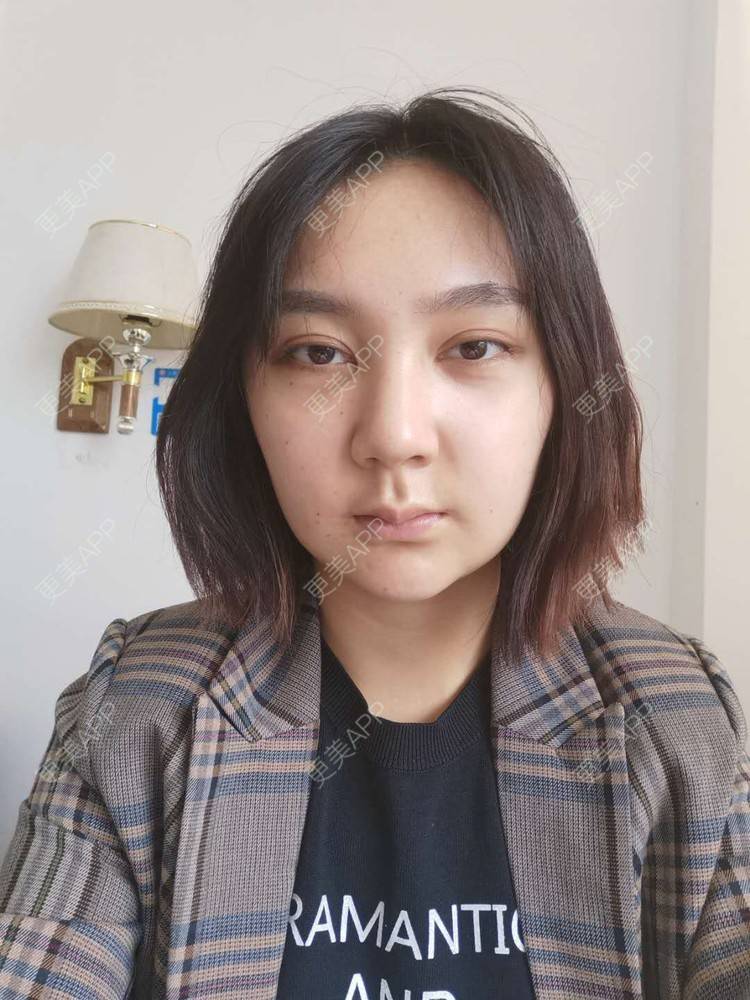 更美 - 更美用户vPlhBD2DXX的自体脂肪丰臀经验 | 自体脂肪丰臀 | 自体脂肪填充面部细纹 | 自体脂肪全面部填充 | 自体脂肪私密紧致