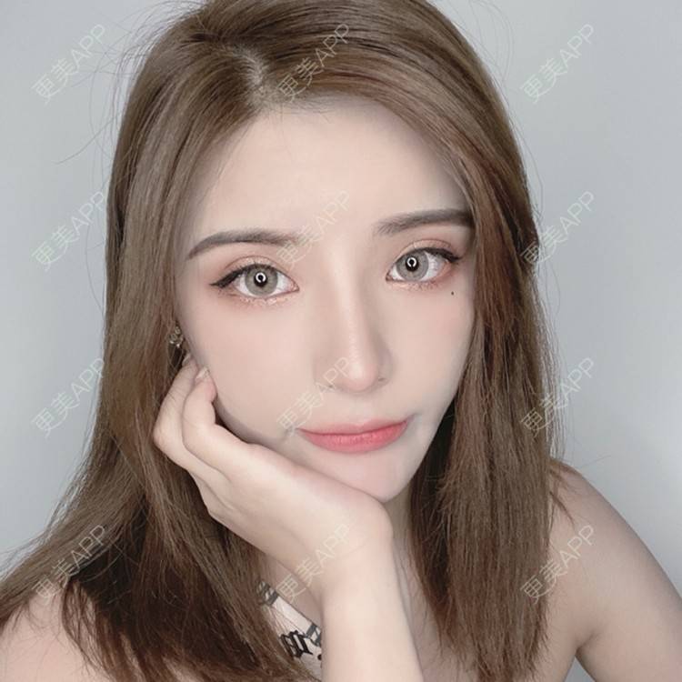更美 - 杨小雯bb的肋软骨隆鼻经验 | 肋软骨隆鼻 | 深圳