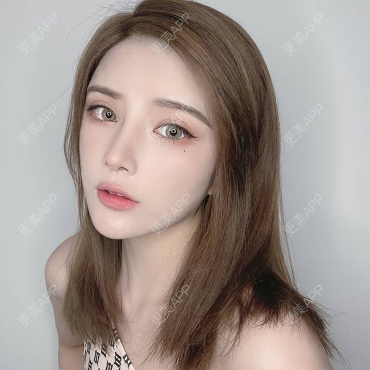 更美 - 杨小雯bb的肋软骨隆鼻经验 | 肋软骨隆鼻 | 深圳