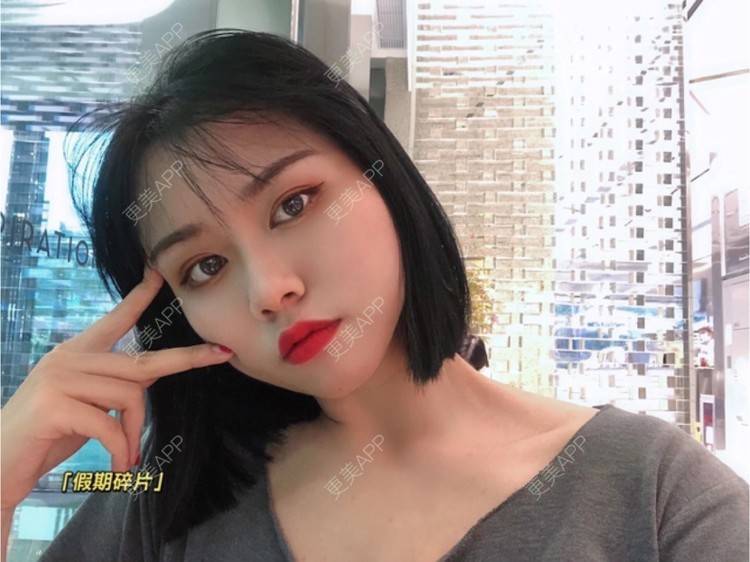 更美 - 玉子燒、的激光脱发际线经验 | 广州 | 大腿脱毛