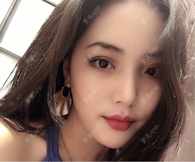 更美 - 名字随便取的鼻部综合经验 | 鼻部综合 | 南昌