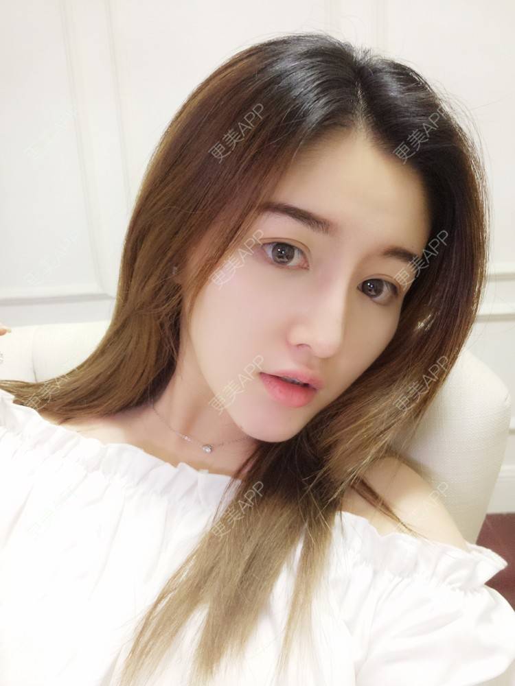 更美 - 雅雅娃的经验 | 肋软骨隆鼻 | 视频日记 | 重庆