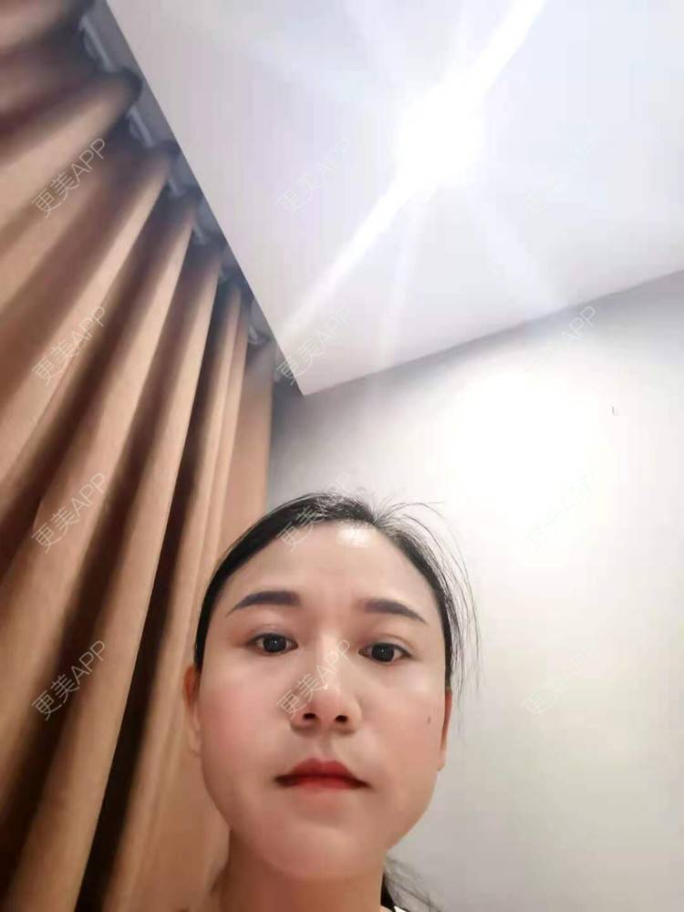 更美 - 更美用户oO6cwBT0l6的额头经验 | 硅胶丰太阳穴 | 太阳穴 | 膨体丰太阳穴 | 自体脂肪丰太阳穴 | 玻尿酸太阳穴 | 额头 | 硅胶丰额头 | 轮廓套餐 | 小切口手术提升