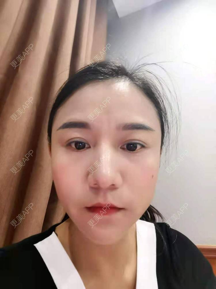 更美 - 更美用户oO6cwBT0l6的额头经验 | 硅胶丰太阳穴 | 太阳穴 | 膨体丰太阳穴 | 自体脂肪丰太阳穴 | 玻尿酸太阳穴 | 额头 | 硅胶丰额头 | 轮廓套餐 | 小切口手术提升
