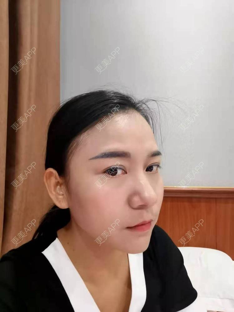 更美 - 更美用户oO6cwBT0l6的额头经验 | 硅胶丰太阳穴 | 太阳穴 | 膨体丰太阳穴 | 自体脂肪丰太阳穴 | 玻尿酸太阳穴 | 额头 | 硅胶丰额头 | 轮廓套餐 | 小切口手术提升