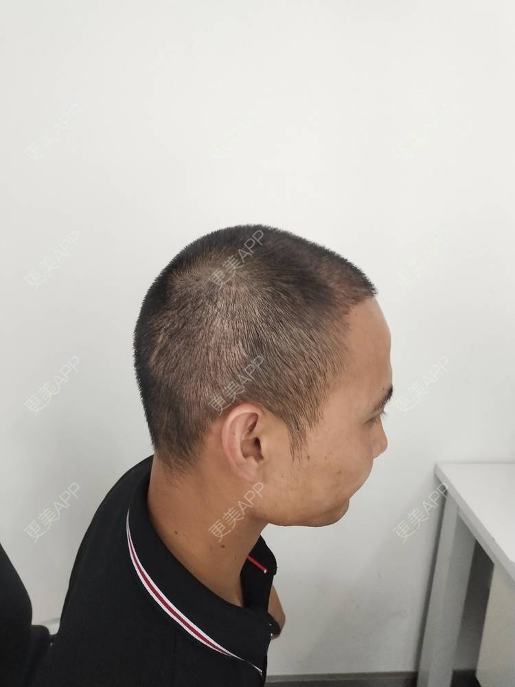 更美 - 更美用户3uyrzcH0tC的鬓角植发经验 | 植发际线 | 鬓角植发 | 成都