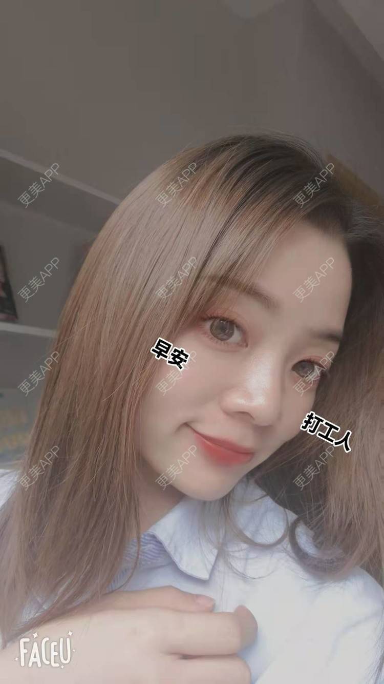 更美 - 随缘补刀吧的内切去眼袋经验 | 北京 | 内切去眼袋
