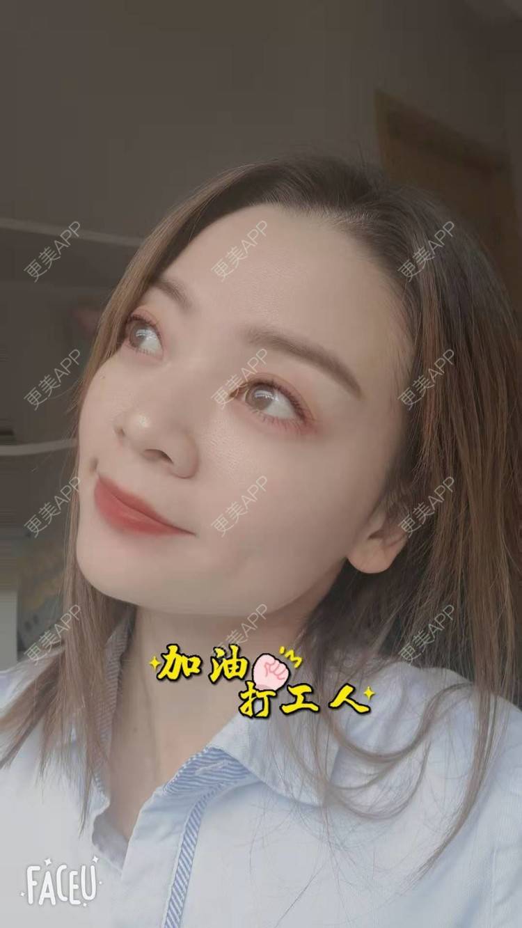 更美 - 随缘补刀吧的内切去眼袋经验 | 北京 | 内切去眼袋