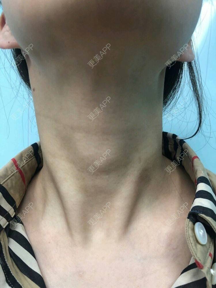 更美 - 更美用户H8z9RMv1GZ的玻尿酸颈纹经验 | 玻尿酸颈纹 | 广州