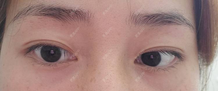 更美 - 更美用户8KgTBC94NY的近视矫正经验 | 近视矫正 | 深圳 | 全飞秒激光术