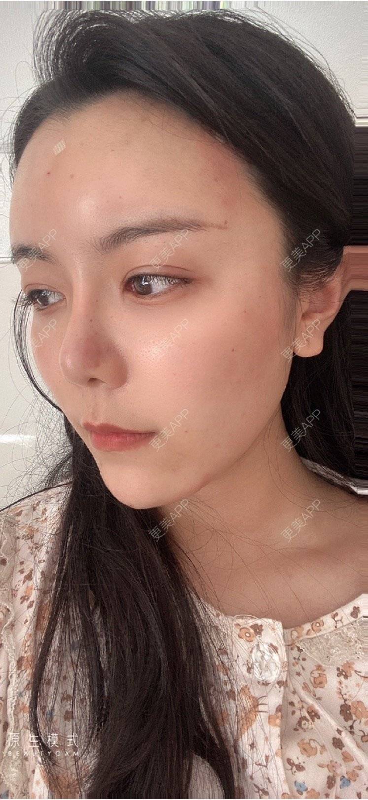 更美 - 15*******01的自体脂肪填充泪沟经验 | 自体脂肪填充泪沟 | 南京