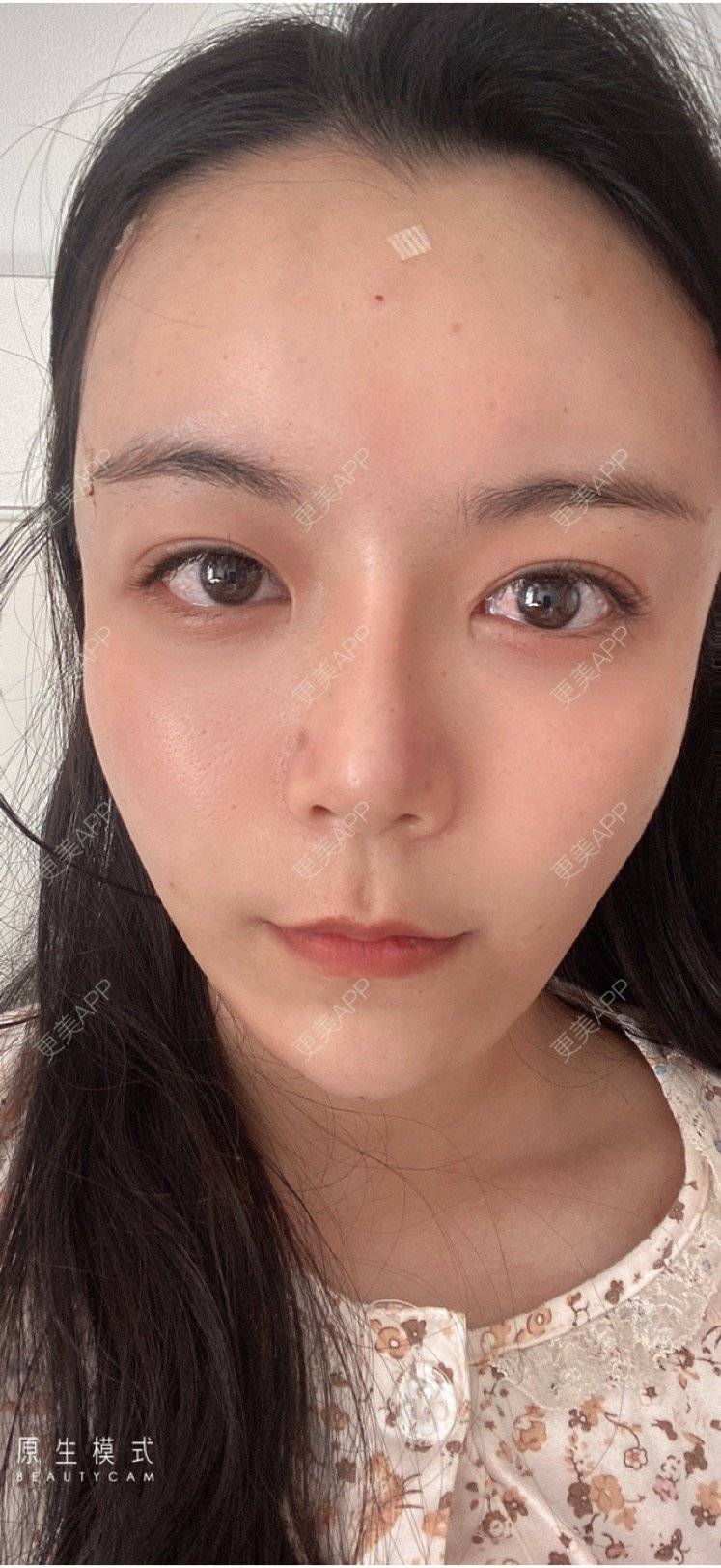 更美 - 15*******01的自体脂肪填充泪沟经验 | 自体脂肪填充泪沟 | 南京