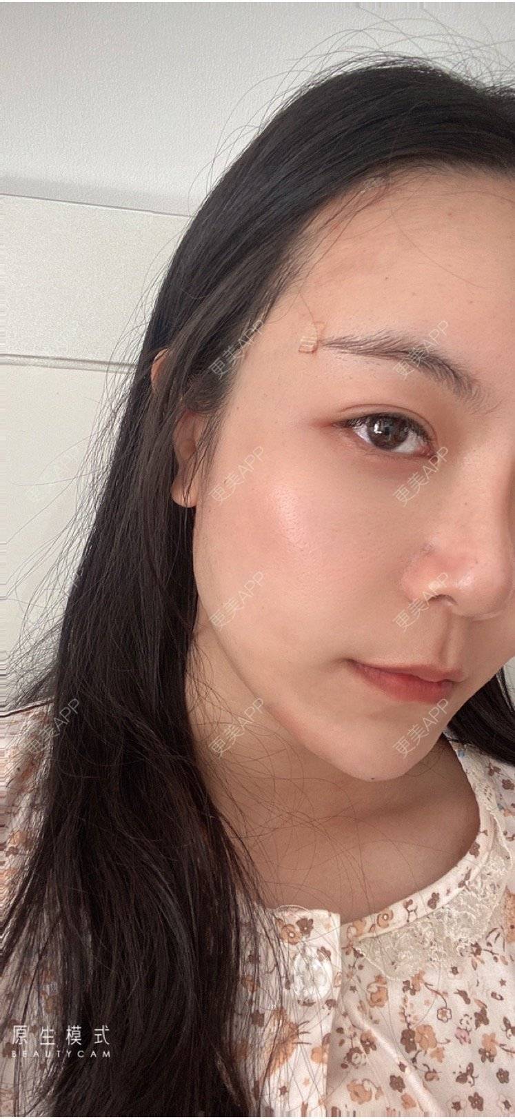 更美 - 15*******01的自体脂肪填充泪沟经验 | 自体脂肪填充泪沟 | 南京