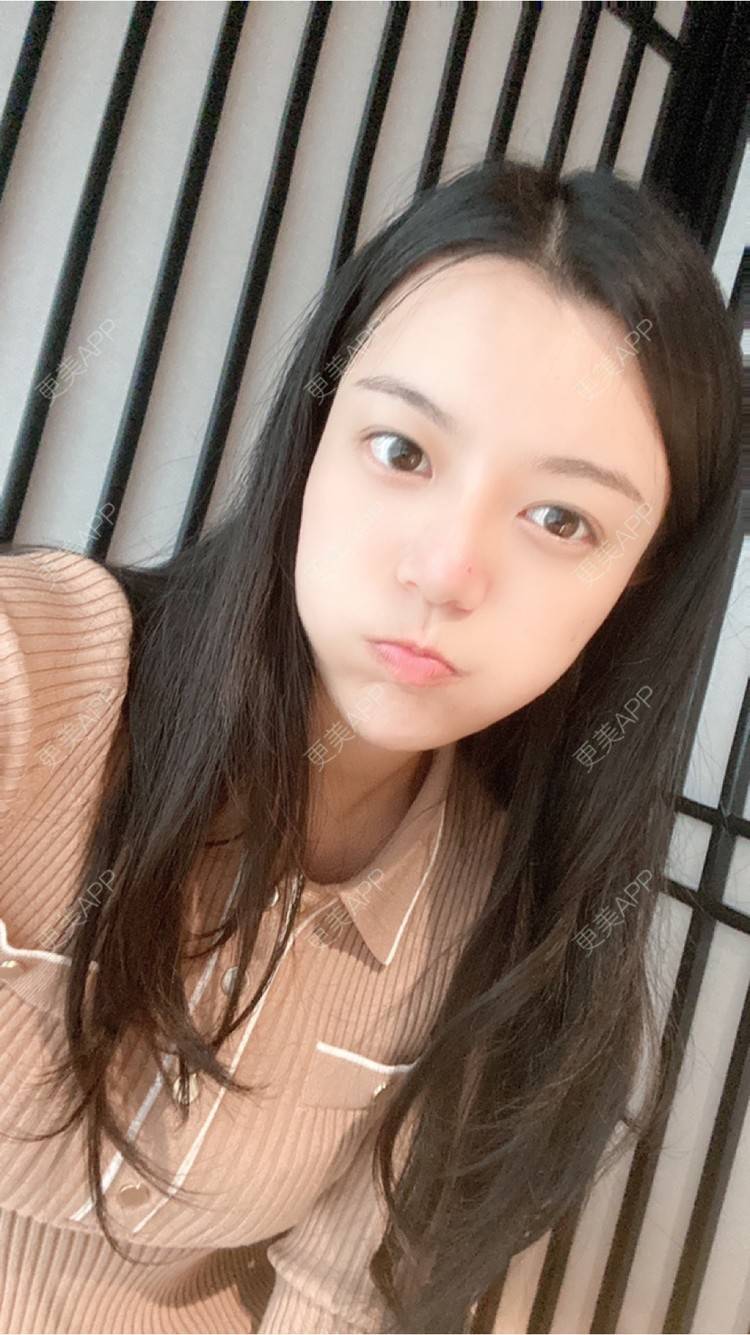 更美 - 15*******01的自体脂肪填充泪沟经验 | 自体脂肪填充泪沟 | 南京