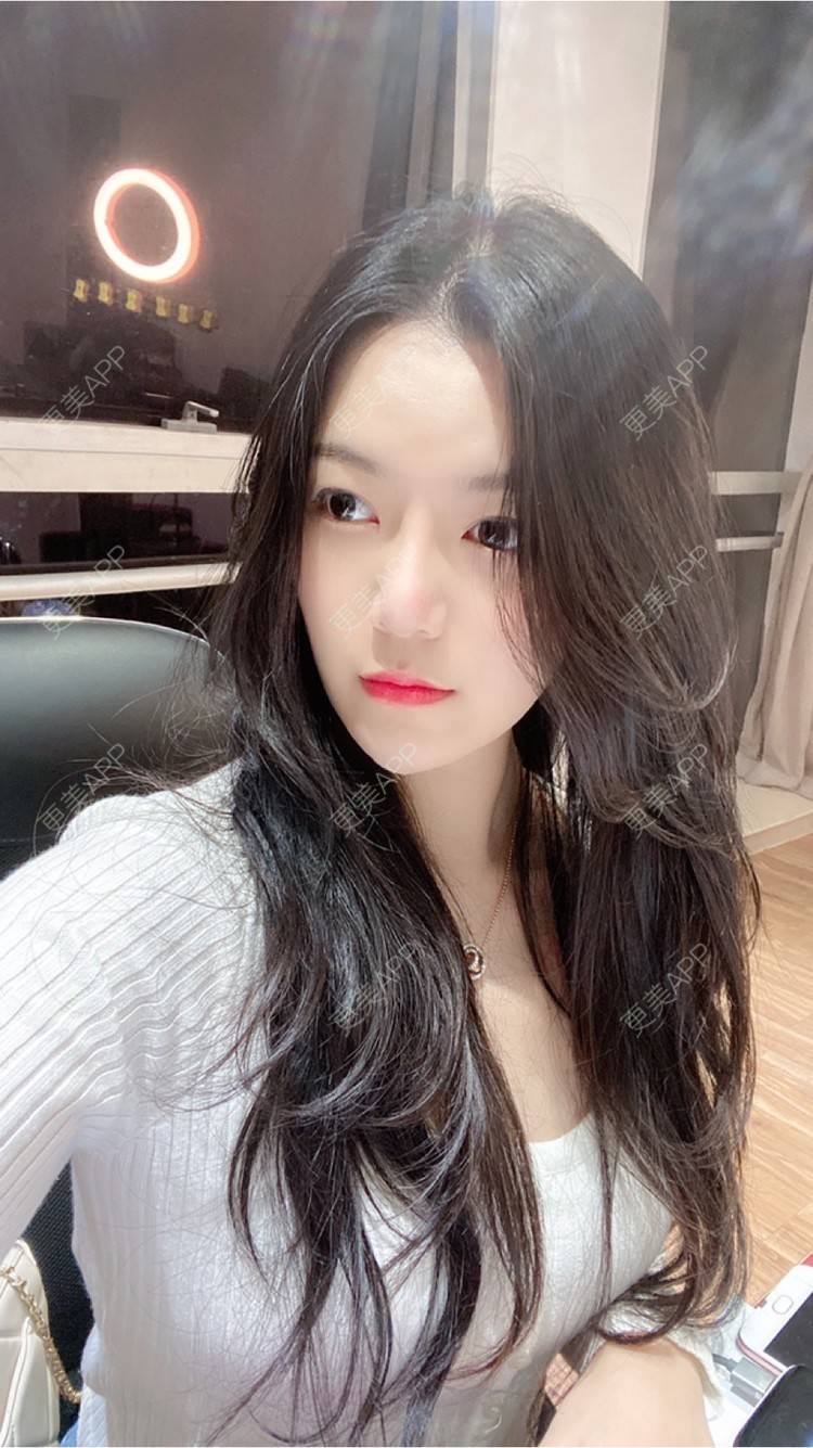 更美 - 15*******01的自体脂肪填充泪沟经验 | 自体脂肪填充泪沟 | 南京