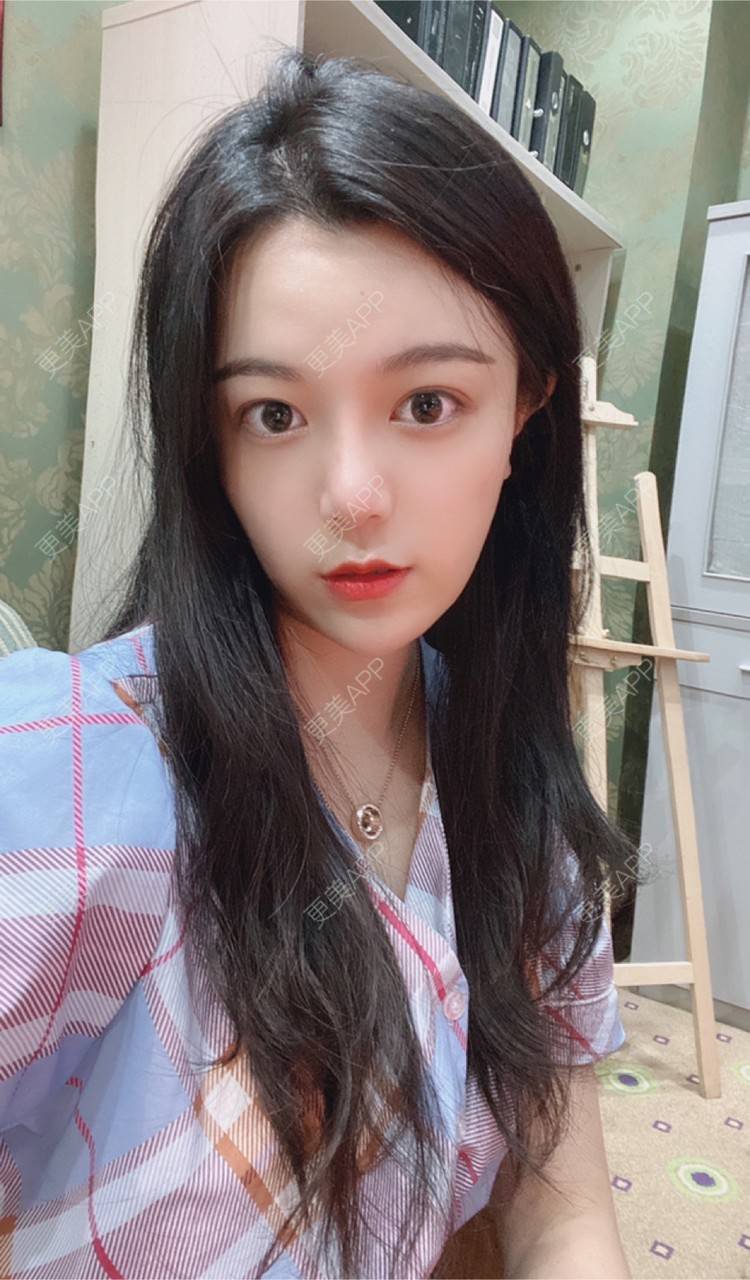 更美 - 15*******01的自体脂肪填充泪沟经验 | 自体脂肪填充泪沟 | 南京