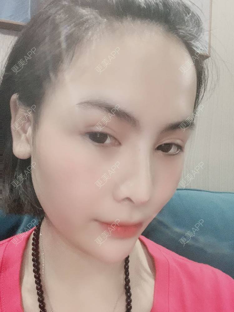 更美 - 怪品味夜的眼部修复经验 | 眼部修复 | 北京 | 双眼皮修复 | 开眼角修复