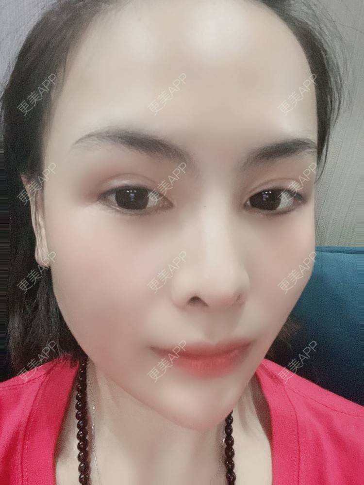 更美 - 怪品味夜的眼部修复经验 | 眼部修复 | 北京 | 双眼皮修复 | 开眼角修复