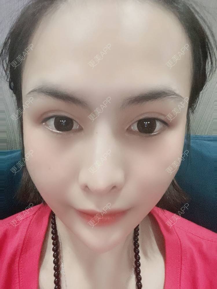 更美 - 怪品味夜的眼部修复经验 | 眼部修复 | 北京 | 双眼皮修复 | 开眼角修复